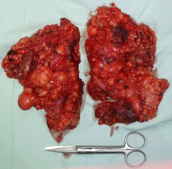 Удаленная жировая ткань