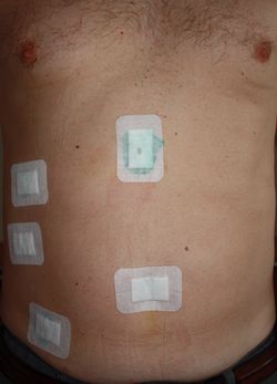 После лапароскопического удаления опухоли почки и желчного пузыря