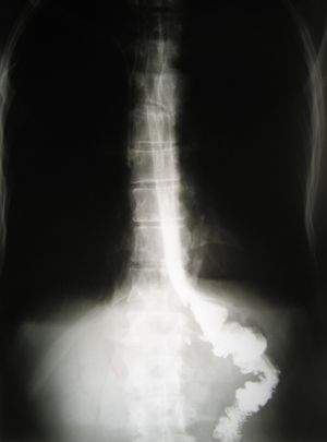 Рентгенограмма пищеводнокишечного анастомоза