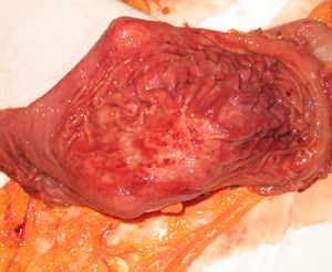 Опухоль желудка