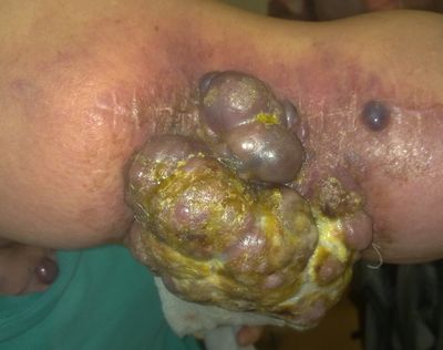 Меланома кожи плеча