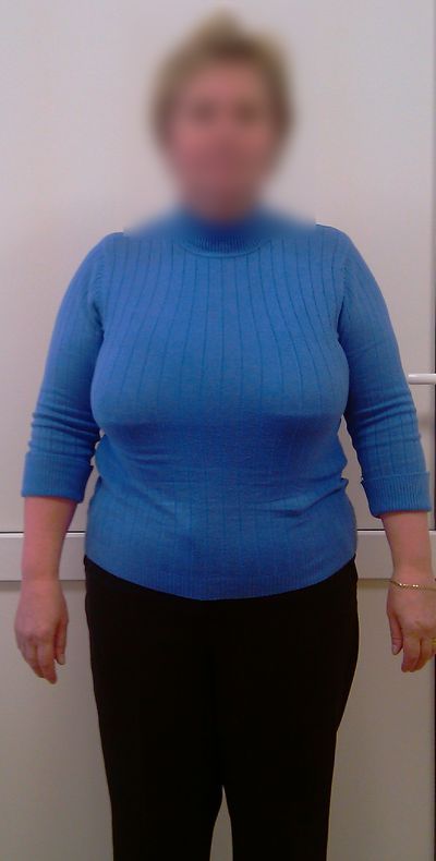 Через 3 года после операции