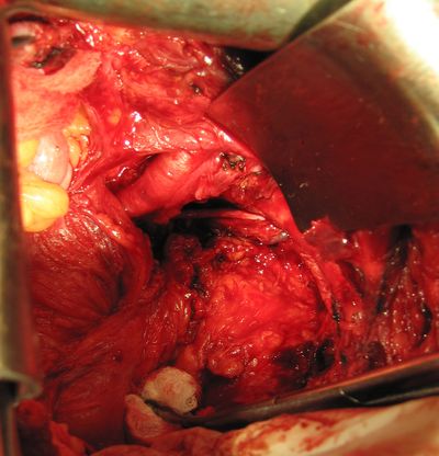 Ложе опухоли после ее удаления