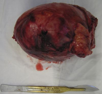 Удаленная опухоль