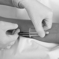 Химиотерпия