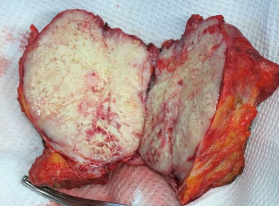 Опухоль на разрезе.