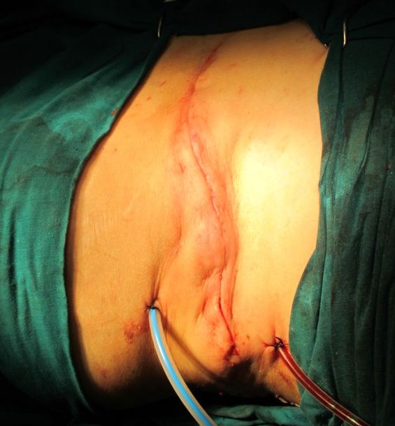 Ушитая операционная рана.