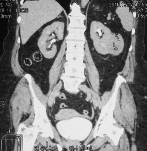 Опухоль левой почки