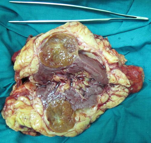 Удаленная почка с опухолью