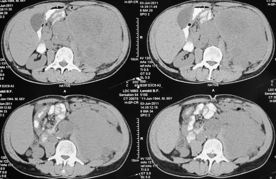Опухоль левой почки