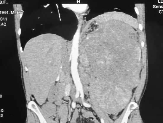 Опухоль левой почки