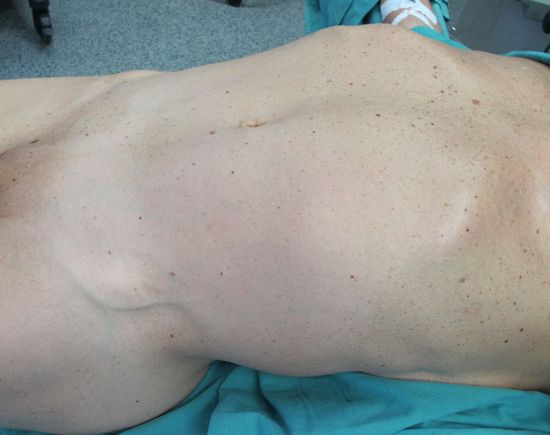 Опухоль левой почки, выпячивающая переднюю брюшную стенку