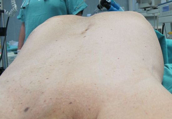 Опухоль левой почки, выпячивающая переднюю брюшную стенку