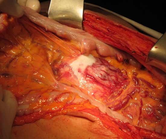 Опухоль левой почки, прорастающая брыжейку толстой кишки