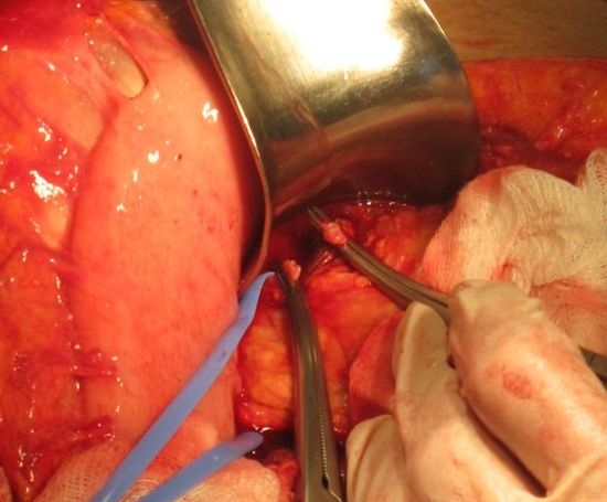 Пересечение селезеночной артерии