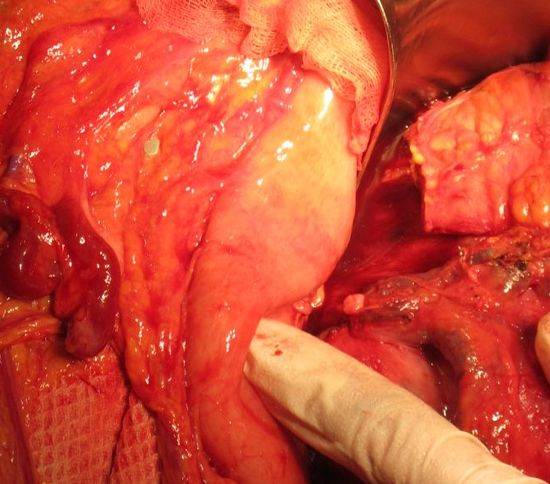 Пересеченная поджелудочная железа