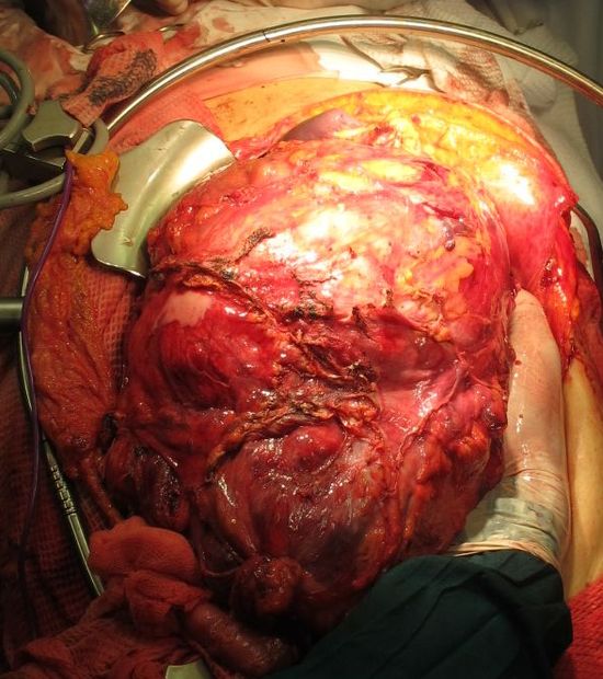 Мобилизация опухолевого конгломерата