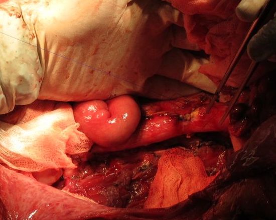 Ушивание дефекта аорты