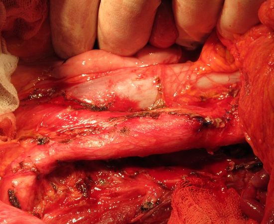 Полноценная лимфаденэктомия (скелетированы аорта, нижняя полая вена и подвздошные сосуды)