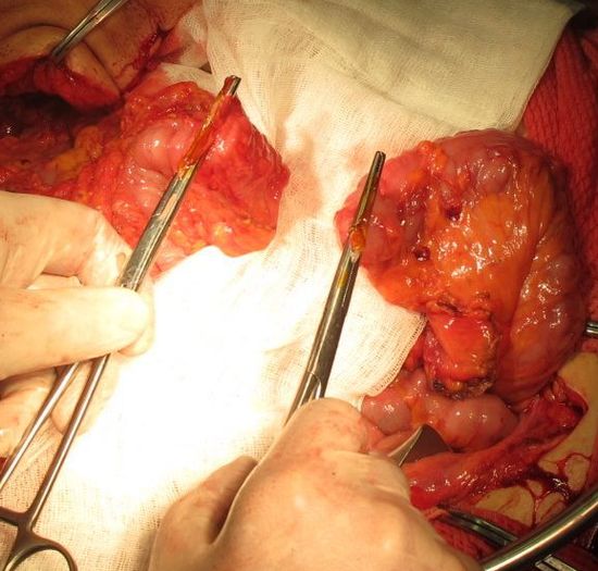 Формирование толстокишечного анастомоза после левосторонней гемиколэктомии