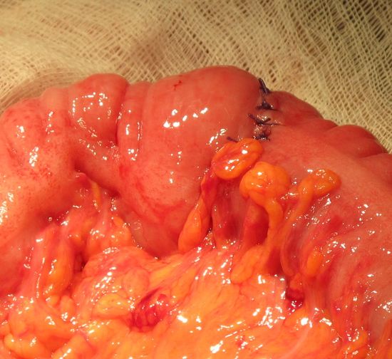 Сформированный толстокишечный анастомоз