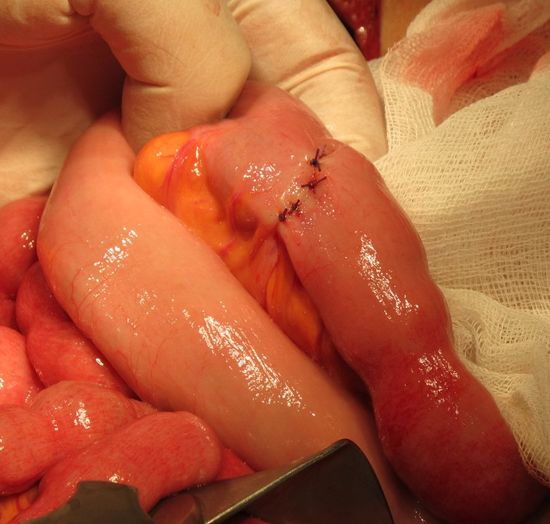 После резекции дивертикула Меккеля