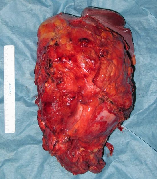 Удаленный опухолевый конгломерат