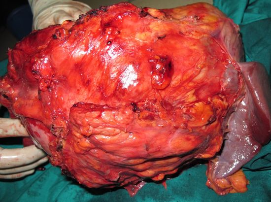 Удаленный опухолевый конгломерат