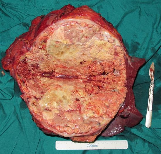 Удаленный опухолевый конгломерат