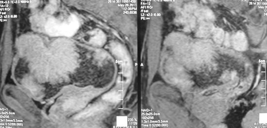 Множественные очаги переходноклеточного рака мочевого пузыря