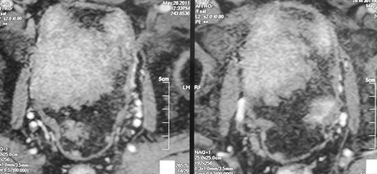 Рецидив рака мочевого пузыря
