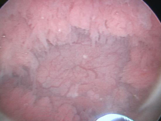 Цистоскопическая картина рака мочевого пузыря