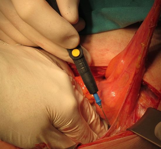 Мобилизация мочевого пузыря