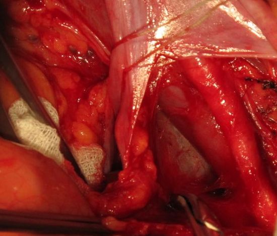 Скелилитизация наружных подвздошных сосудов с сохранением семевыносящего протока