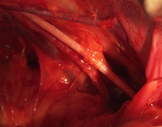 Обтураторная лимфодиссекция