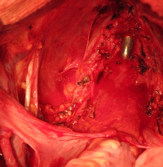 Ложе удаленного мочевого пузыря (сохраненные 2/3 предстательной железы, сосудисто-нервные пучки, семенные пузырьки и семевыносящие протоки)